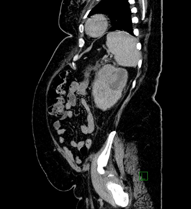 Chromophobe renal cell carcinoma (Radiopaedia 84239-99519 G 28).jpg