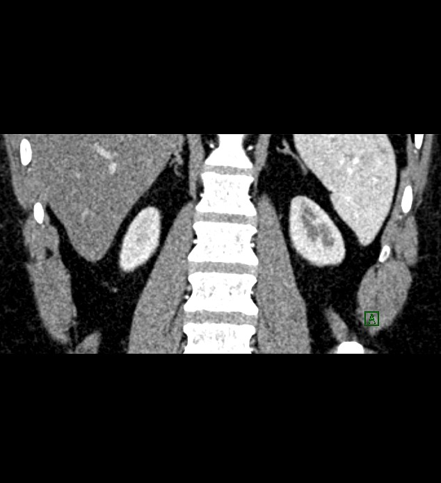 Chromophobe renal cell carcinoma (Radiopaedia 84286-99573 E 68).jpg