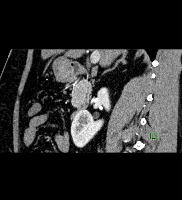 Chromophobe renal cell carcinoma (Radiopaedia 84286-99573 F 103).jpg