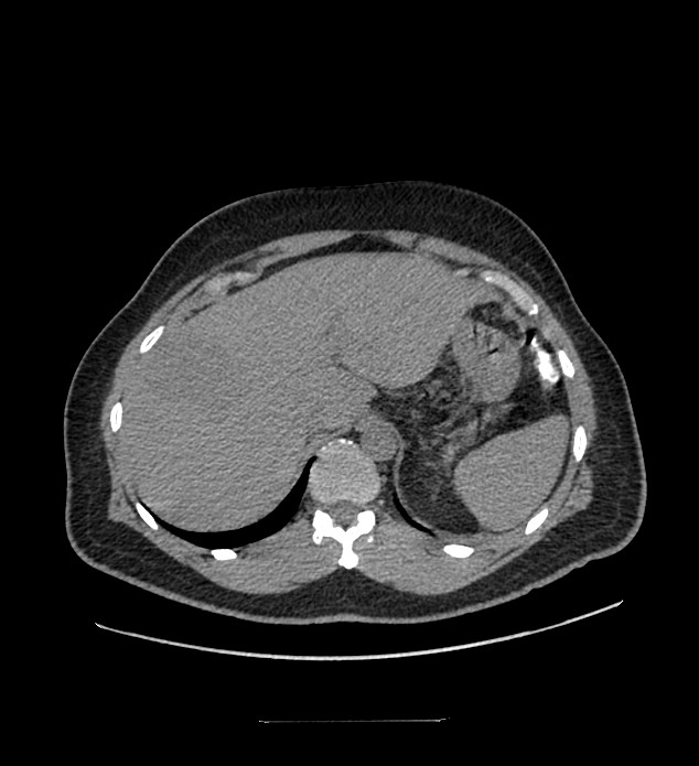 Chromophobe renal cell carcinoma (Radiopaedia 84337-99644 Axial non-contrast 18).jpg