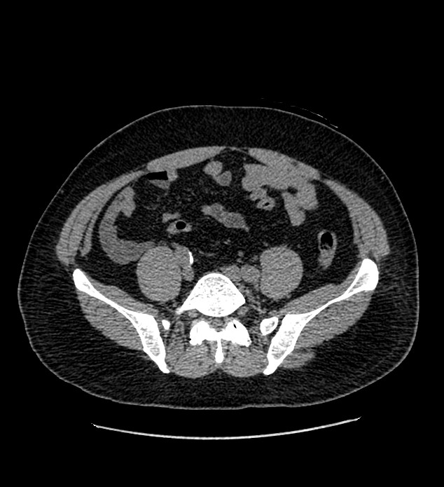 Chromophobe renal cell carcinoma (Radiopaedia 84337-99693 Axial non-contrast 110).jpg