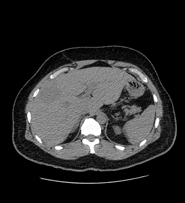 Chromophobe renal cell carcinoma (Radiopaedia 84337-99693 Axial non-contrast 25).jpg
