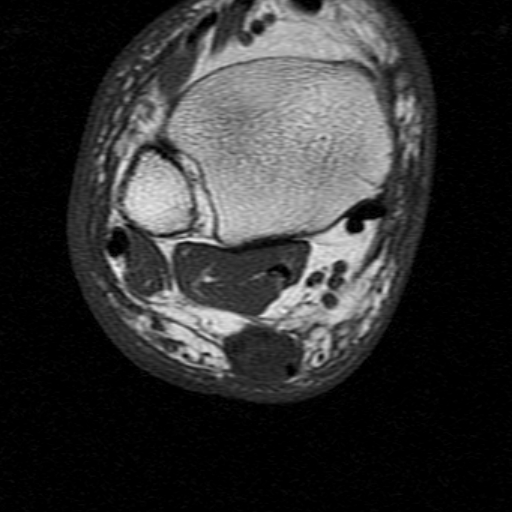 File:Chronic Achilles tendon rupture (Radiopaedia 15262-15100 Axial T1 9).jpg