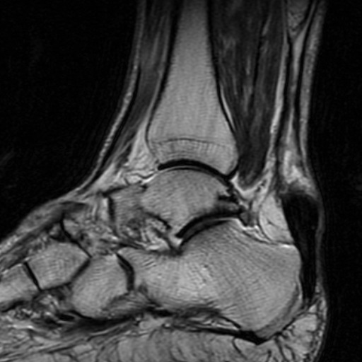 File:Chronic Achilles tendon rupture (Radiopaedia 15262-15100 Sagittal T2 6).jpg