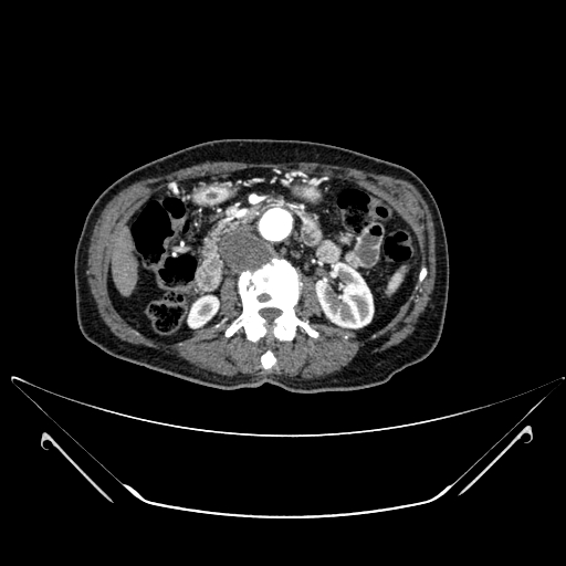 Chronic contained rupture of abdominal aortic aneurysm with extensive erosion of the vertebral bodies (Radiopaedia 55450-61901 A 23).jpg
