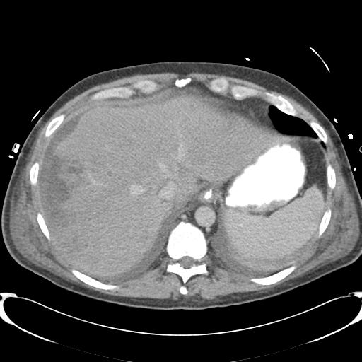Chronic diverticulitis complicated by hepatic abscess and portal vein thrombosis (Radiopaedia 30301-30938 A 16).jpg