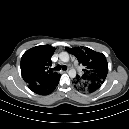 Chronic eosinophilic pneumonia (Radiopaedia 39331-41587 Axial C+ delayed 44).png