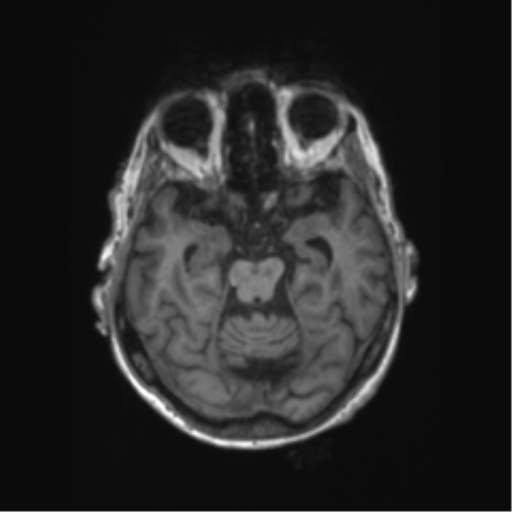 Chronic hypertensive encephalopathy (Radiopaedia 72844-83495 Axial T1 47).png