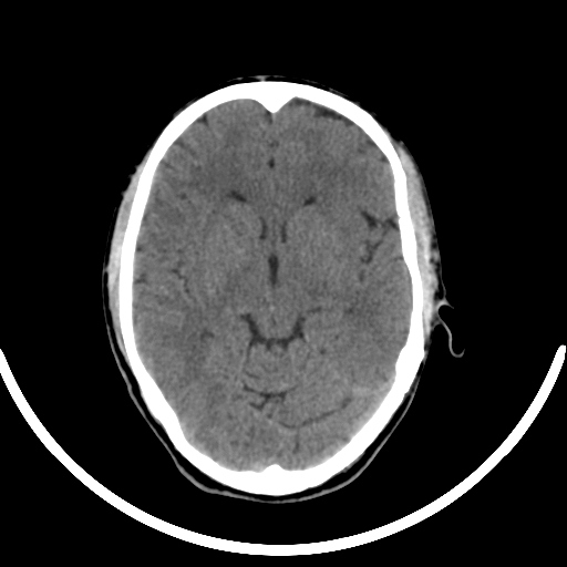 Chronic invasive fungal sinusitis with intraorbital and intracranial extension (Radiopaedia 56387-63046 Axial non-contrast 187).jpg