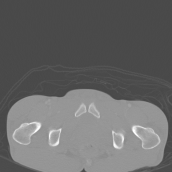 Chronic large bowel pseudo-obstruction (Radiopaedia 43181-46492 Axial bone window 163).jpg
