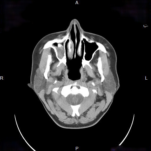 File:Chronic maxillary sinusitis with a foreign body (dental filling material) (Radiopaedia 7811-8639 Axial non-contrast 2).jpg