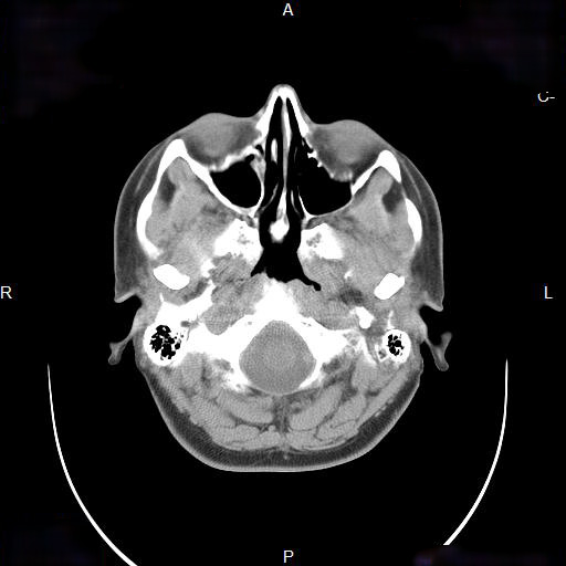 File:Chronic maxillary sinusitis with a foreign body (dental filling material) (Radiopaedia 7811-8639 Axial non-contrast 6).jpg