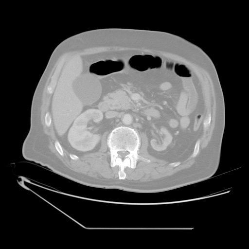 File:Chronic mesenteric ischemia - arterial (Radiopaedia 88205-104810 Axial lung window 6).jpg