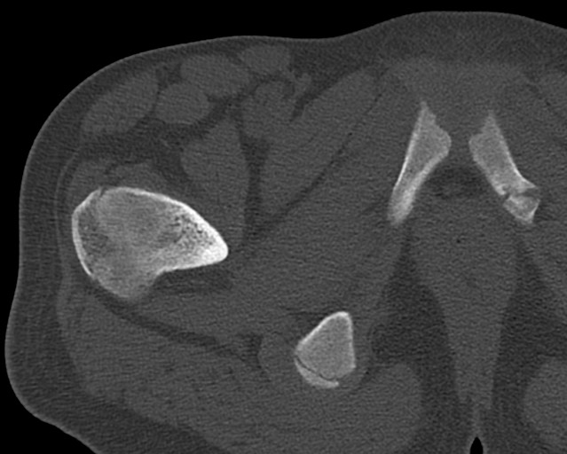 Chronic ostemyelitis of the femur with long sinus tract (Radiopaedia 74947-85982 Axial bone window 13).jpg