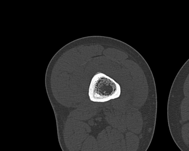 Chronic ostemyelitis of the femur with long sinus tract (Radiopaedia 74947-85982 Axial bone window 133).jpg