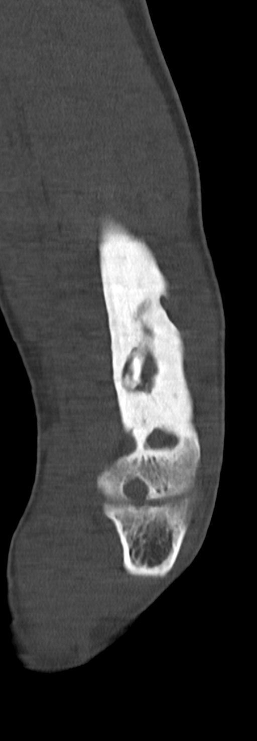 Chronic osteomyelitis of the distal humerus (Radiopaedia 78351-90971 Sagittal bone window 53).jpg