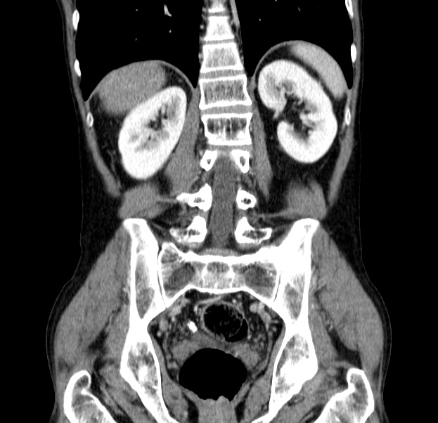 Chronic pancreatitis (Radiopaedia 23132-23172 C 43).jpg