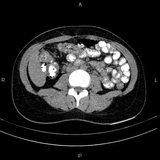 Chronic pancreatitis (Radiopaedia 64576-73450 Axial non-contrast 87).jpg