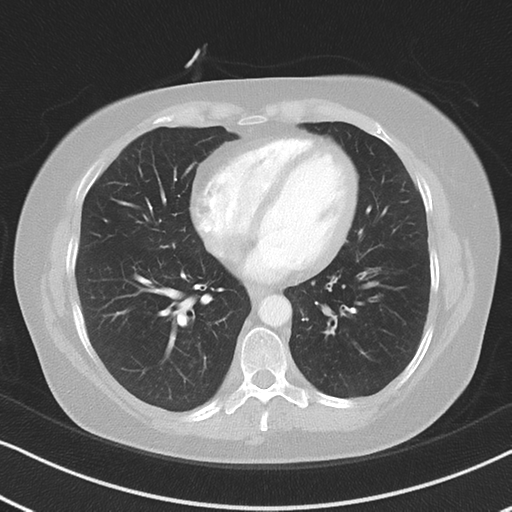 Chronic pulmonary embolus (Radiopaedia 39129-41341 Axial lung window 41).png