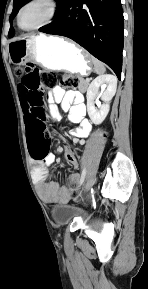 Chronic small bowel volvulus (Radiopaedia 75224-86322 C 52).jpg