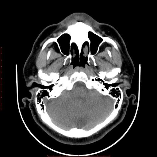 Chronic submandibular sialolithiasis (Radiopaedia 69817-79814 Axial non-contrast 12).jpg