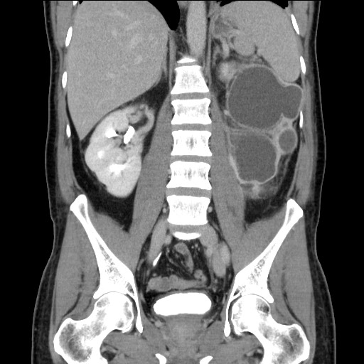 Chronic ureteropelvic junction obstruction (Radiopaedia 78365-90996 B 61).jpg