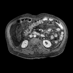 File:Cirrhosis and hepatocellular carcinoma in the setting of hemochromatosis (Radiopaedia 75394-86594 Axial T1 C+ fat sat 270).jpg