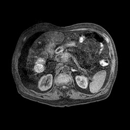 Cirrhosis and hepatocellular carcinoma in the setting of hemochromatosis (Radiopaedia 75394-86594 Axial T1 C+ fat sat 34).jpg