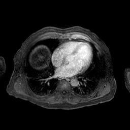 Cirrhosis and hepatocellular carcinoma in the setting of hemochromatosis (Radiopaedia 75394-86594 Axial T1 C+ fat sat 342).jpg