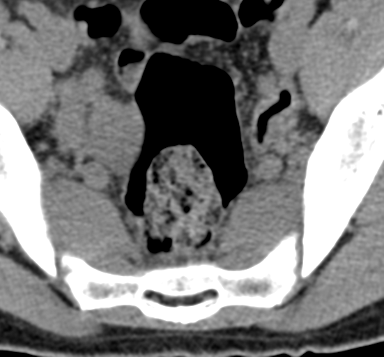 File:Clear cell meningoma - lumbar spine (Radiopaedia 60116-67691 Axial non-contrast 83).png