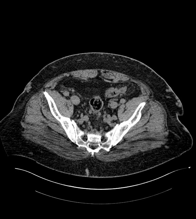 Closed-loop small bowel obstruction-internal hernia (Radiopaedia 78439-91096 Axial non-contrast 128).jpg