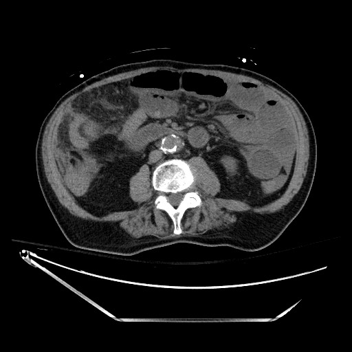 Closed loop obstruction due to adhesive band, resulting in small bowel ischemia and resection (Radiopaedia 83835-99023 Axial non-contrast 81).jpg