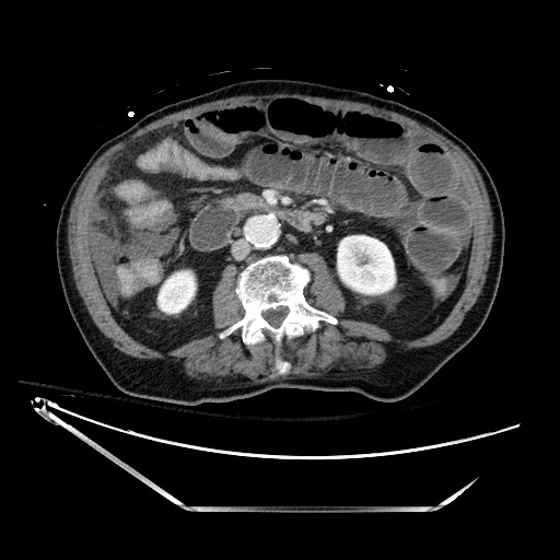 Closed loop obstruction due to adhesive band, resulting in small bowel ischemia and resection (Radiopaedia 83835-99023 D 75).jpg