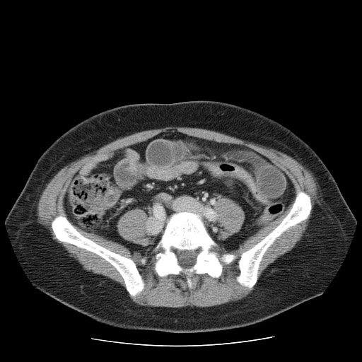 File:Closed loop small bowel obstruction (Radiopaedia 65403-74451 A 53).jpg