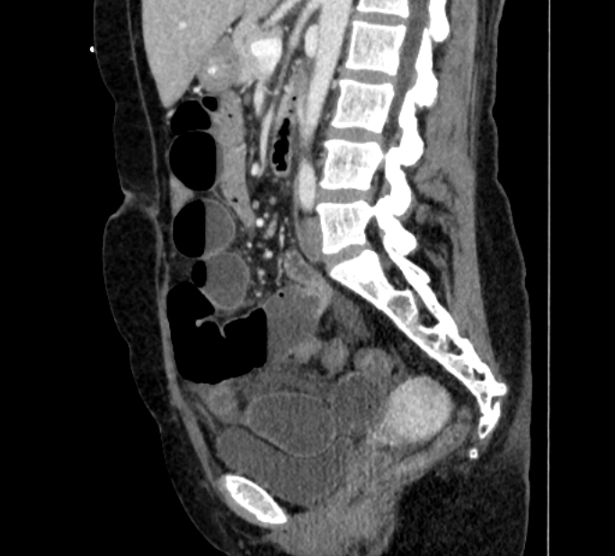 Closed loop small bowel obstruction (Radiopaedia 71211-81508 C 81).jpg