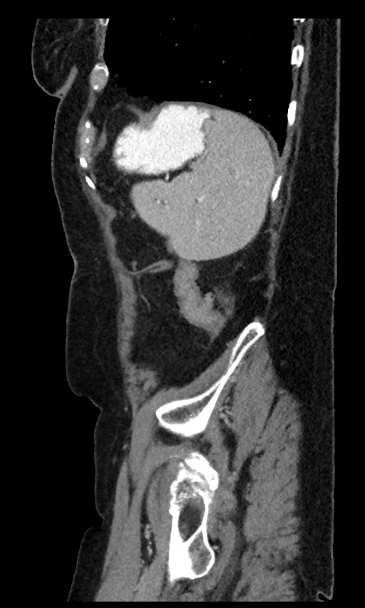 Closed loop small bowel obstruction - adhesions (Radiopaedia 59269-66611 C 22).jpg