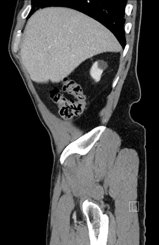 Closed loop small bowel obstruction - internal hernia (Radiopaedia 57806-64778 C 93).jpg