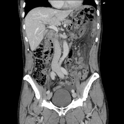 File:Closed loop small bowel obstruction - omental adhesion causing "internal hernia" (Radiopaedia 85129-100682 B 59).jpg