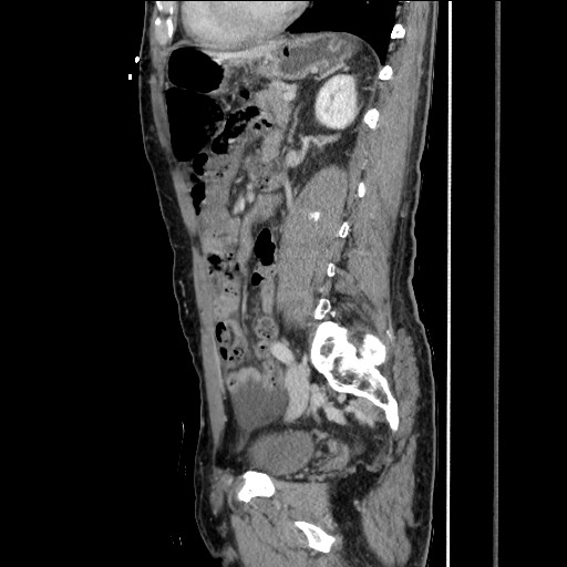 Closed loop small bowel obstruction - omental adhesion causing "internal hernia" (Radiopaedia 85129-100682 C 113).jpg