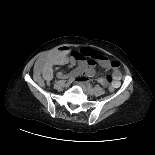 Closed loop small bowel obstruction due to adhesive band, with intramural hemorrhage and ischemia (Radiopaedia 83831-99017 Axial non-contrast 106).jpg