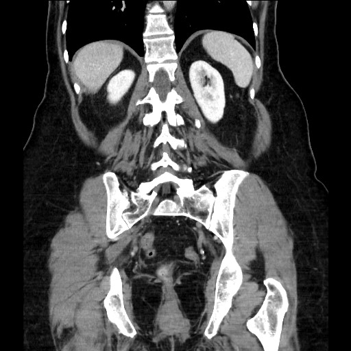 Closed loop small bowel obstruction due to adhesive bands - early and late images (Radiopaedia 83830-99014 B 92).jpg