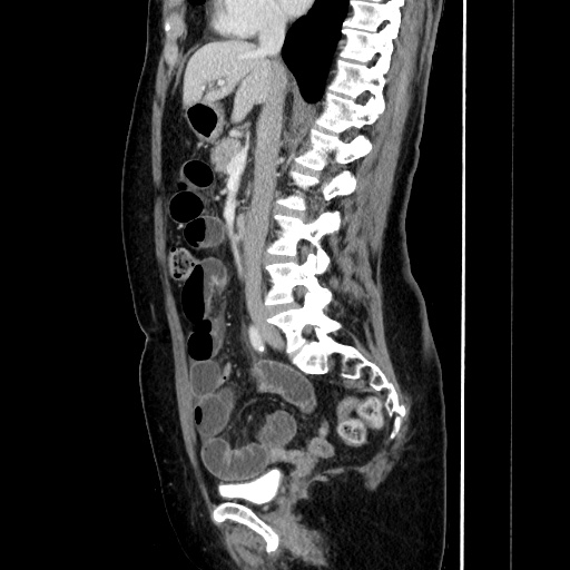 Closed loop small bowel obstruction due to adhesive bands - early and late images (Radiopaedia 83830-99015 C 84).jpg