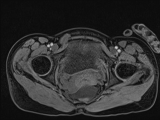 Closed loop small bowel obstruction in pregnancy (MRI) (Radiopaedia 87637-104031 G 21).jpg