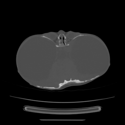 Cloverleaf skull (Radiopaedia 91901-109710 Axial bone window 70).jpg
