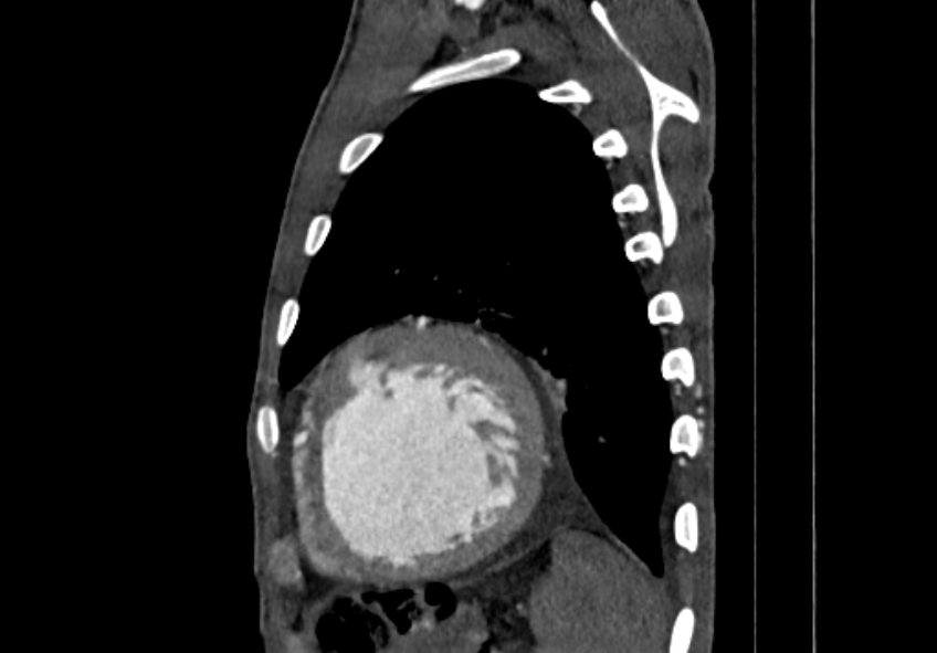 Coarctation of aorta with aortic valve stenosis (Radiopaedia 70463-80574 B 191).jpg