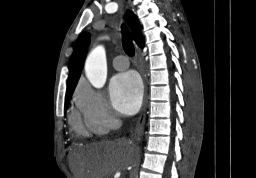 Coarctation of aorta with aortic valve stenosis (Radiopaedia 70463-80574 B 42).jpg
