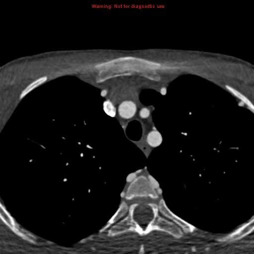 File:Coarctation of the aorta (Radiopaedia 12461-12697 A 5).jpg