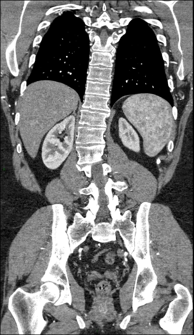 Coarctation of the aorta (Radiopaedia 74632-88521 B 181).jpg
