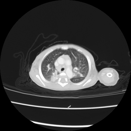 Coarctation of the aorta and patent ductus arteriosus (Radiopaedia 68033-77499 Axial lung window 15).jpg