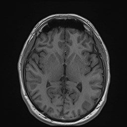 File:Cochlear incomplete partition type III associated with hypothalamic hamartoma (Radiopaedia 88756-105498 Axial T1 104).jpg